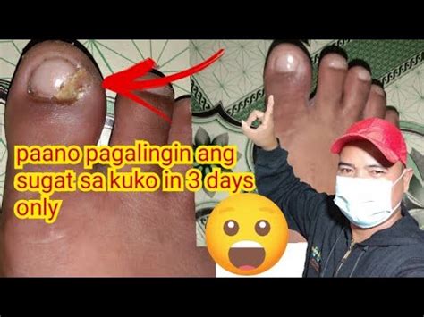 Sugat Sa Paa .
